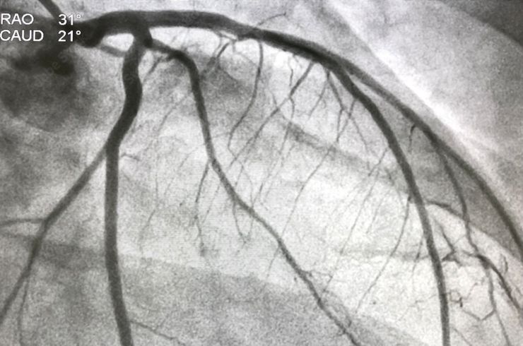 Coronary Angiography