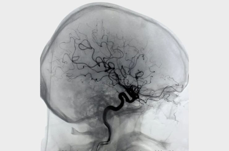 Fluoroscopy, Digital Subtraction Angiography